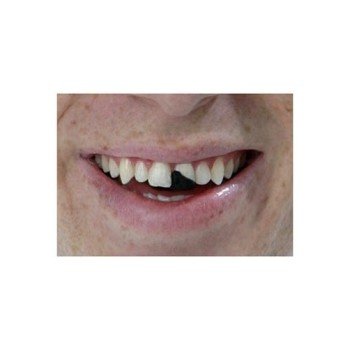 Dente Quebrado Lóide Luxo Os Debilóides Adulto Dente Quebrado Lóide Luxo Os Debilóides Adulto